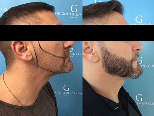 Barttransplantation vorher und nachher