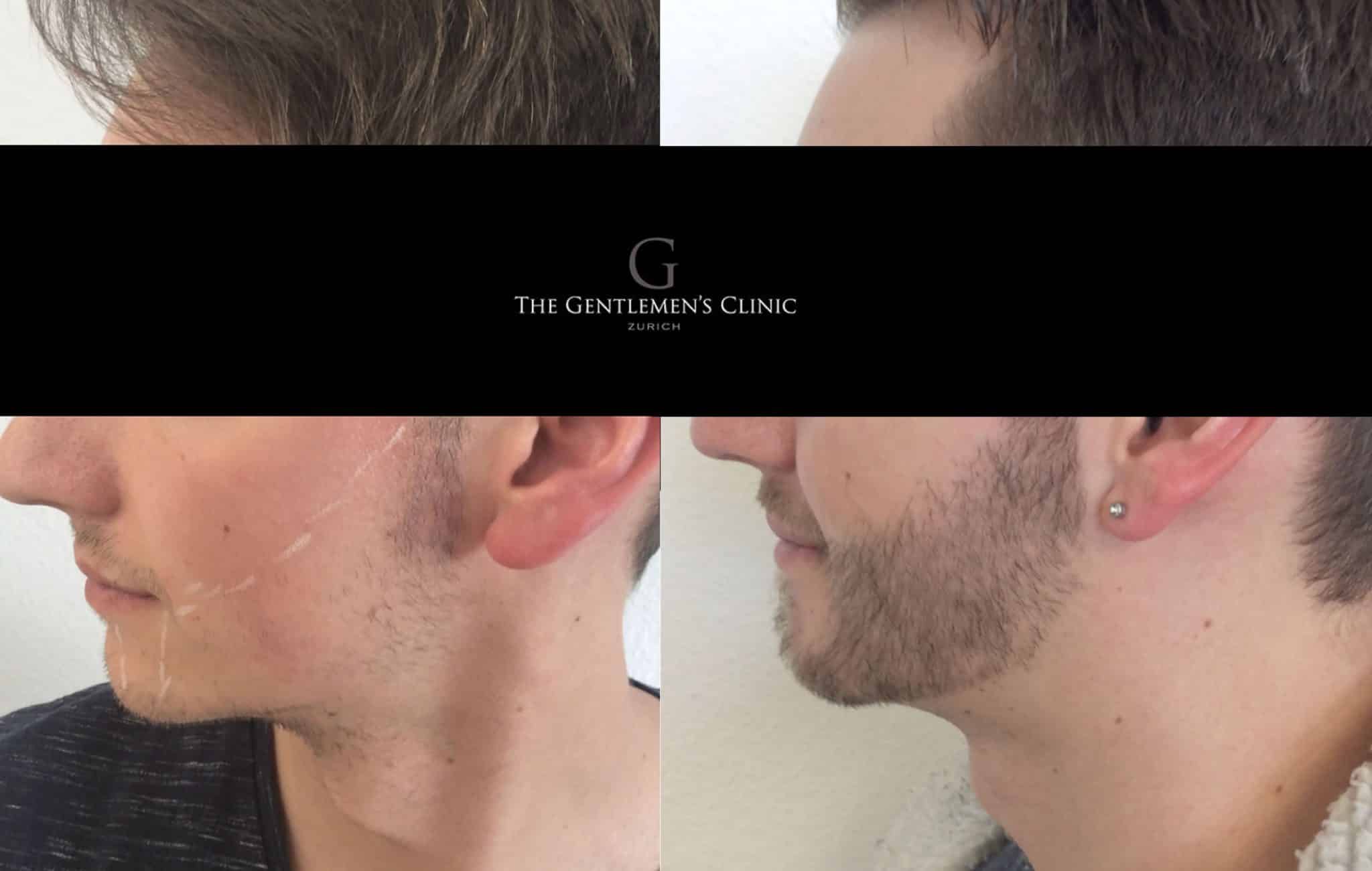 Barttransplantation vorher und nachher