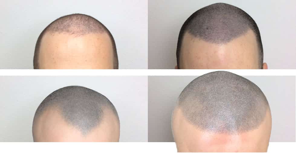 Scalp Micropigmentation
