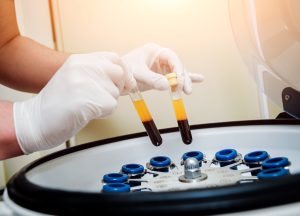 PRP Eigenbluttherapie